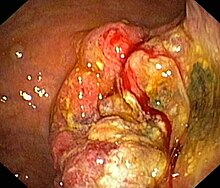 220px-Magenkrebs.jpg